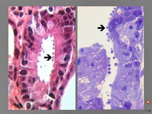 M,33y. | cryptosporidiosis - duodenum, im | munodeficient pacient, HE and toluidine blue staining M,33y. | cryptosporidiosis - duodenum, im | munodeficient pacient, HE and toluidine blue staining